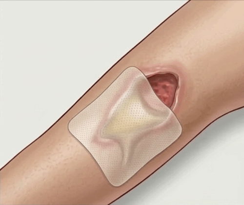 mextra superabsorbent krytie na extrémne secernujúce rany